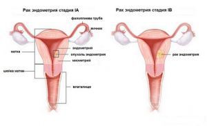 Эндометриоидный рак тела матки: лечение, прогноз, признаки, причины, симптомы