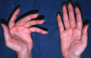 Ревматоидный артрит запястья руки: симптомы, лечение, причины, признаки