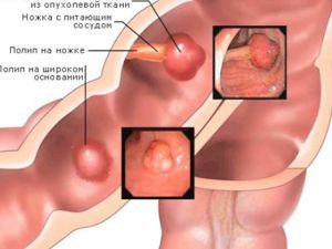 Полипы прямой кишки: симптомы, лечение, признаки, причины, диагностика