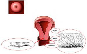 Дисплазия шейки матки, степени, лечение, симптомы, причины, признаки. Дисплазия при беременности