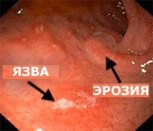 Эктопическая слизистая оболочка желудка