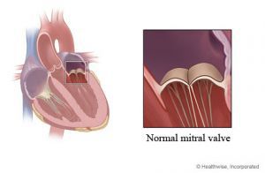 Митральный стеноз клапана сердца: что это такое, лечение, симптомы, причины, признаки