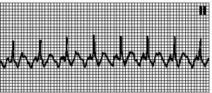 Тахикардия с широкими комплексами qrs