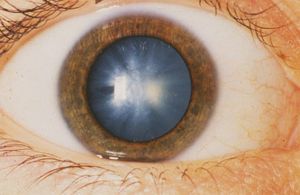 Катаракта глаза: народное лечение, симптомы, причины, признаки, профилактика