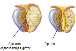 Рак уретры: симптомы, лечение, причины, признаки