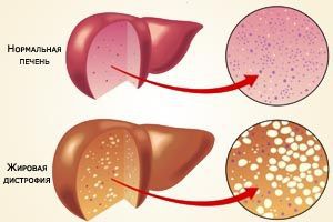 Неалкогольная жировая болезнь печени: лечение