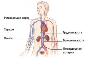 Диссекция аорты: классификация, причины, симптомы, лечение, что это такое?