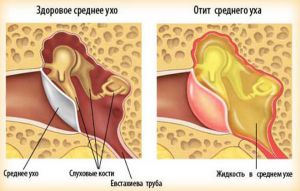 Хронический гнойный средний отит уха: лечение, осложнения, причины, симптомы, признаки
