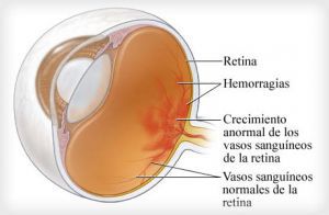 Диабетическая ретинопатия и непролиферативная диабетическая ретинопатия (НПДР)