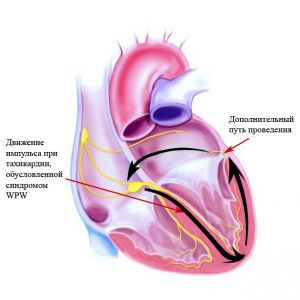 Дополнительные проводящие пути (синдром Вольфа-Паркинсона-Уайта)