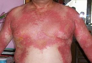 Стафилококковый синдром ошпаренной кожи: лечение, причины, симптомы, признаки