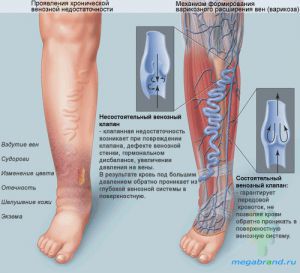 Варикозное расширение вен нижних конечностей на ногах, лечение, симптомы