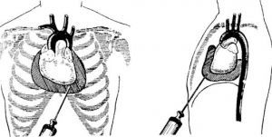 Пункция полости перикарда