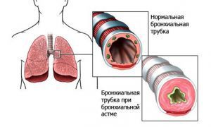 Врожденные пороки развития бронхов