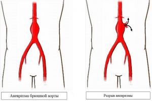 Аневризмы брюшной аорты (брюшного отдела): симптомы, лечение, диагностика, причины, признаки