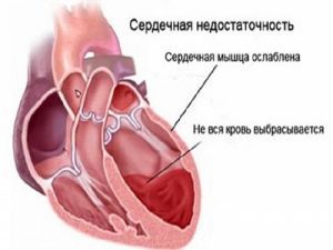 Сердечная недостаточность: что это такое, симптомы, лечение, признаки, причины, неотложная помощь, классификация