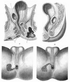 Свищи аноректальные. Свищи аортокишечные. Свищи трахеопищеводные