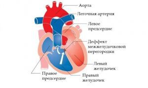 Дефект межпредсердной перегородки у детей: лечение, причины, симптомы