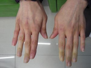 Сосудистые заболевания пальцев рук
