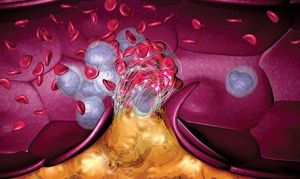 Тромбозы и эмболии легочной артерии