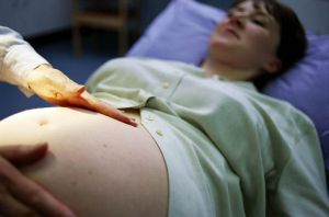 Болезнь Верльгофа (тромбоцитопеническая пурпура) при беременности