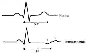 Гипокалиемия: что это такое, симптомы, причины, лечение, признаки