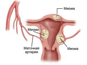 Фиброзная опухоль матки, симптомы, лечение, причины, признаки