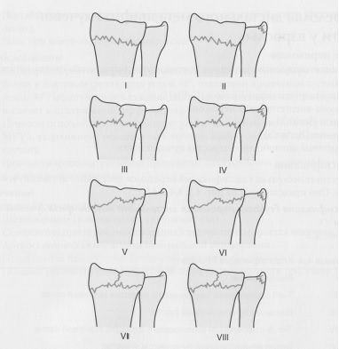 Классификация переломов дистального эпиметафиза лучевой кости