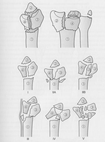 Классификация переломов дистального эпиметафиза лучевой кости