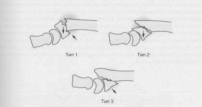 Классификация переломов дистального эпиметафиза лучевой кости