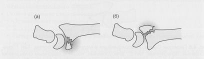 Классификация переломов дистального эпиметафиза лучевой кости