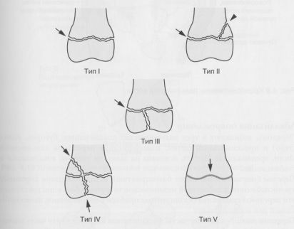 Классификация переломов дистального эпиметафиза лучевой кости