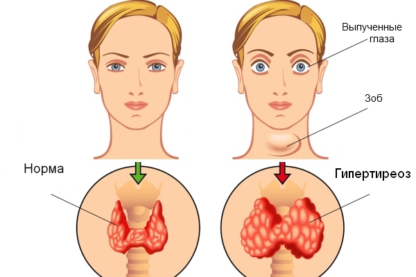 Гипертиреоз щитовидной железы