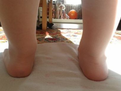 Плосковальгусная стопа у детей, лечение