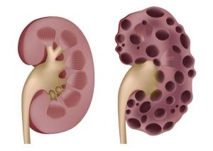 Поликистозная болезнь почек: что это такое, причины, лечение, признаки, симптомы