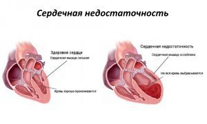 Сердечно сосудистая недостаточность: симптомы, лечение, причины, признаки, первая помощь