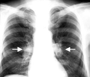 Туберкулез внутригрудных лимфатических узлов: лечение, осложнения, причины, симптомы