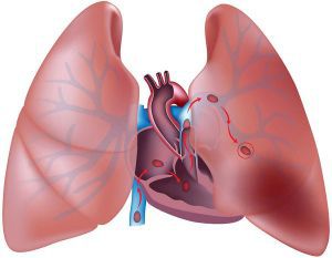 Тромбоэмболия легочной артерии: лечение, симптомы, причины, признаки, диагностика