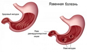 Язва желудка: что это такое, симптомы, причины, признаки, лечение