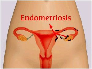 Сочетание миомы с эндометриозом: признаки, лечение, симптомы, причины