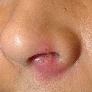 Дерматит на слизистой носа лечение thumbnail