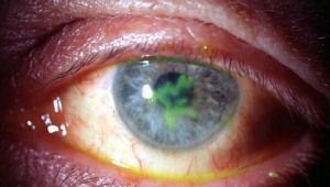 Язва роговицы глаза у человека: лечение, симптомы