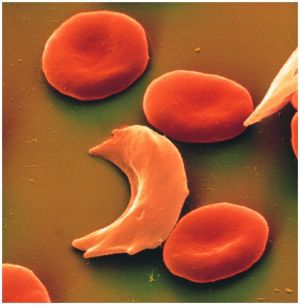 Серповидноклеточная анемия: что это такое, симптомы, причины, лечение, признаки