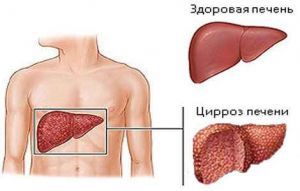 Компенсированный цирроз печени: симптомы, лечение, признаки, причины