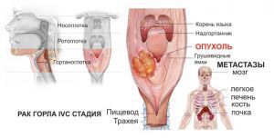 Опухоли (рак) головы и шеи: симптомы, лечение, причины, признаки