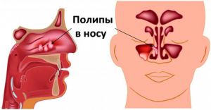 Полипы в носу: что это такое, лечение, симптомы, причины, признаки