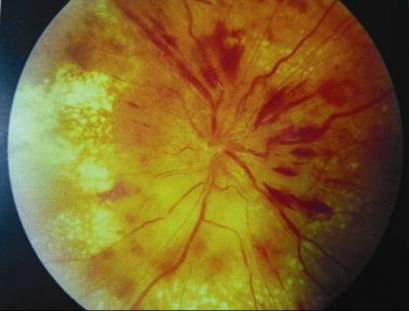 Застойный диск зрительного нерва при гипертензионно-гидроцефальном синдроме