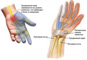 Компрессия срединного нерва Компрессия срединного нерва