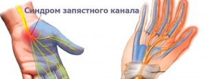 Синдром запястного канала: что это такое, лечение, симптомы, признаки, причины