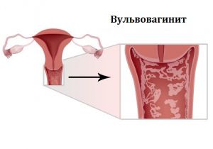 Вульвовагинит: что это такое, лечение, причины, симптомы, признаки